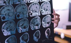 SALUD: DEMENCIA AFECTA A 57 MILLONES DE PERSONAS
